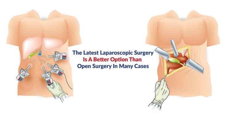Laparoscopic Surgery
