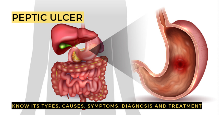 duodenal ulcer pain location