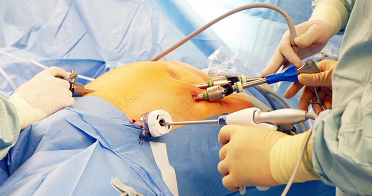 Why Laparoscopic Surgery Is Best In Case Of Sports Hernia?